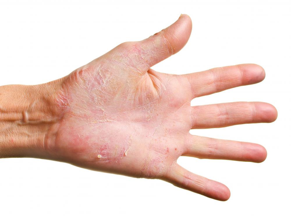 Dermatitis herpetiformis is a telltale sign of gluten intolerance.