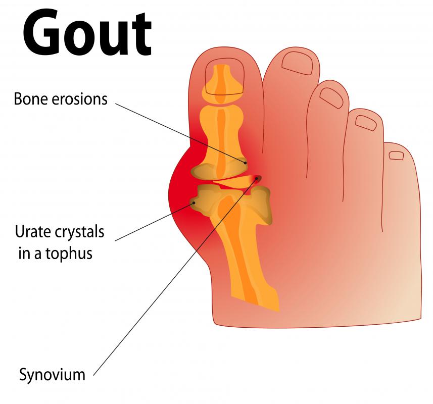 Cherries may help relieve symptoms of gout and other arthritic diseases.