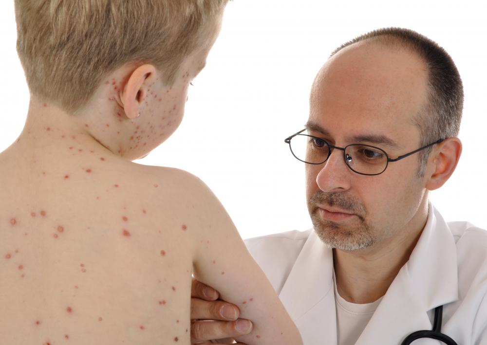 Colloidal oatmeal baths can help sooth the itch of the chicken pox.