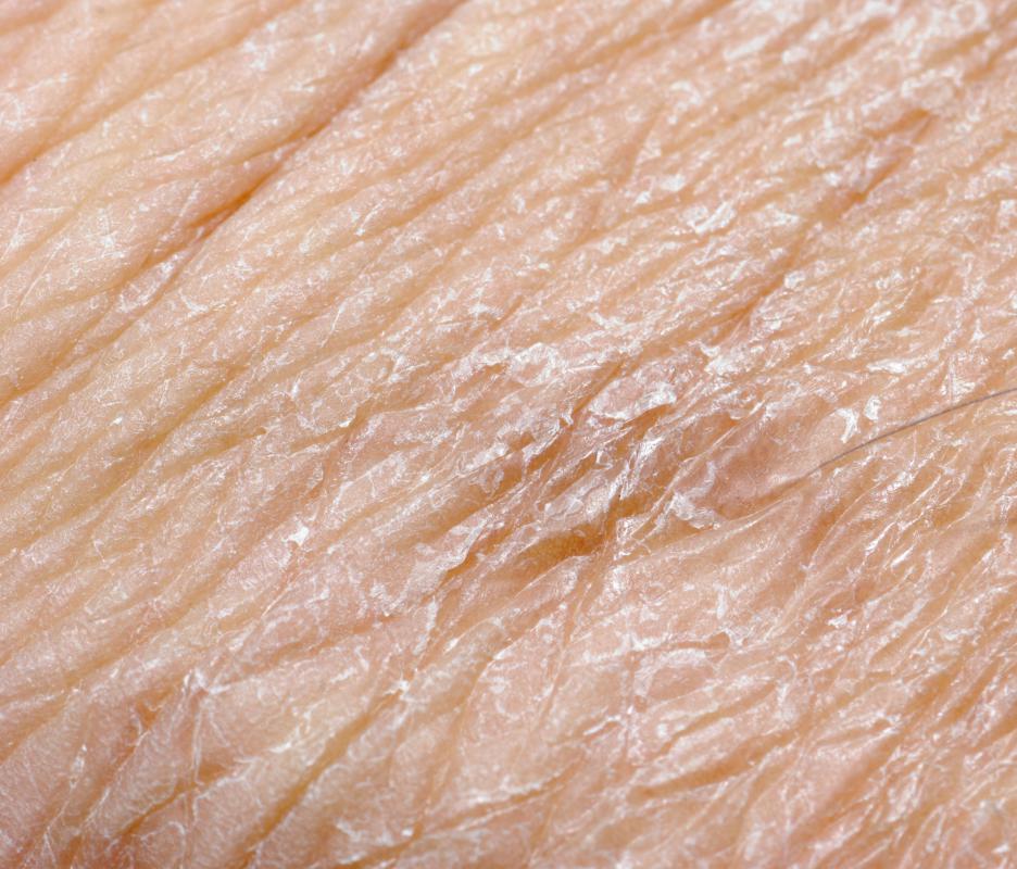 Alkaline water can help relieve dry skin.