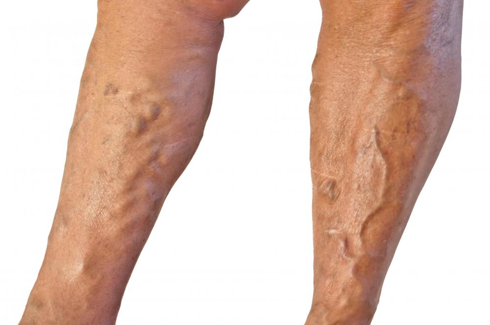 Some proponents of bilberries say it gives them relief from varicose veins.