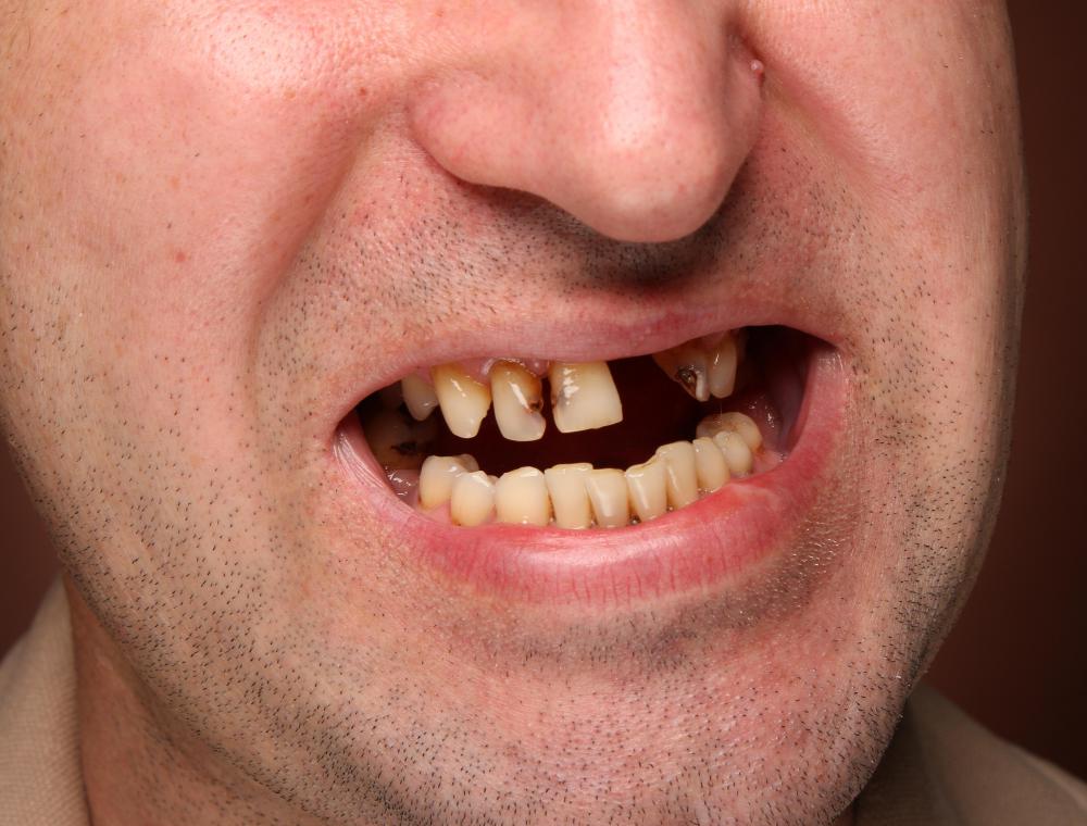 Excessive consumption of sugary substances, such as jawbreakers, may cause tooth decay.