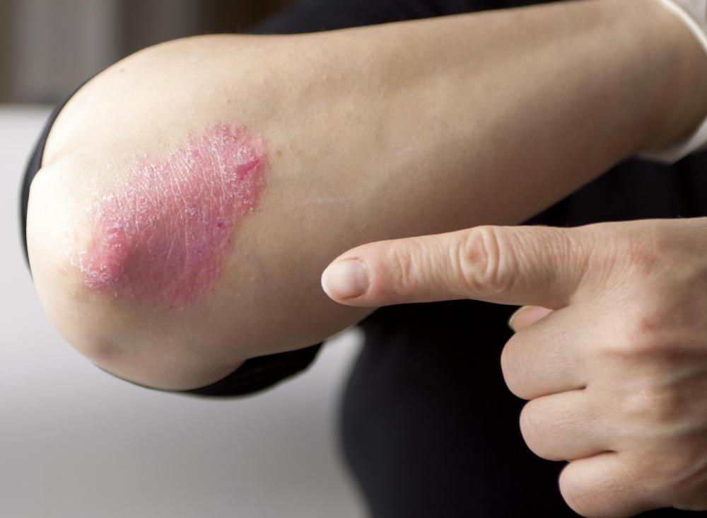Sesame oil may help prevent psoriasis.