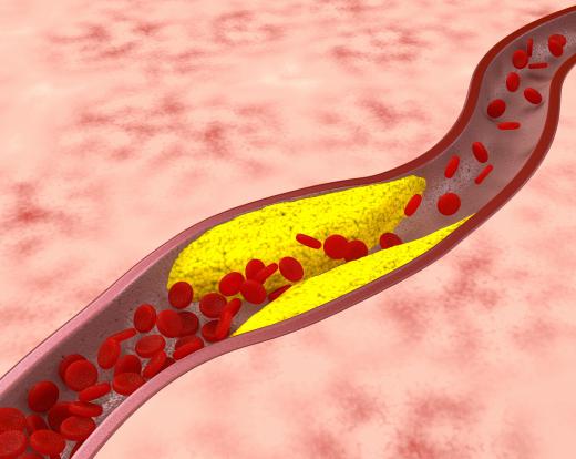 Quinoa bread may help treat atherosclerosis, which is the narrowing of the arteries.