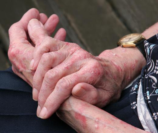 Coming into contact with poison ivy may cause a red, itchy rash to appear at the contact site.