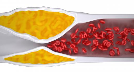 Omega-3 fatty acids reduce levels of triglyceride, which is associated with the buildup of plaque in arteries.