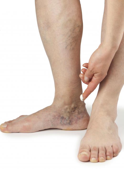 Many believe that mustard oil can reduce the appearance of spider veins.