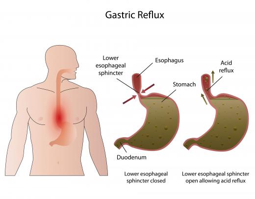 Those with bad instances of acid reflux may benefit from vanilla syrup.