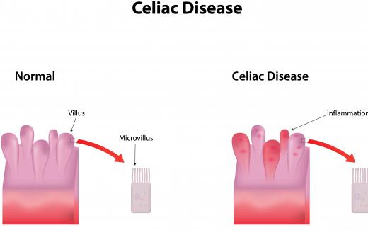 The vanilla bean itself is not harmful to those with celiac disease, but additives found in powdered vanilla that's used in high-volume kitchens may be problematic for celiac patients.