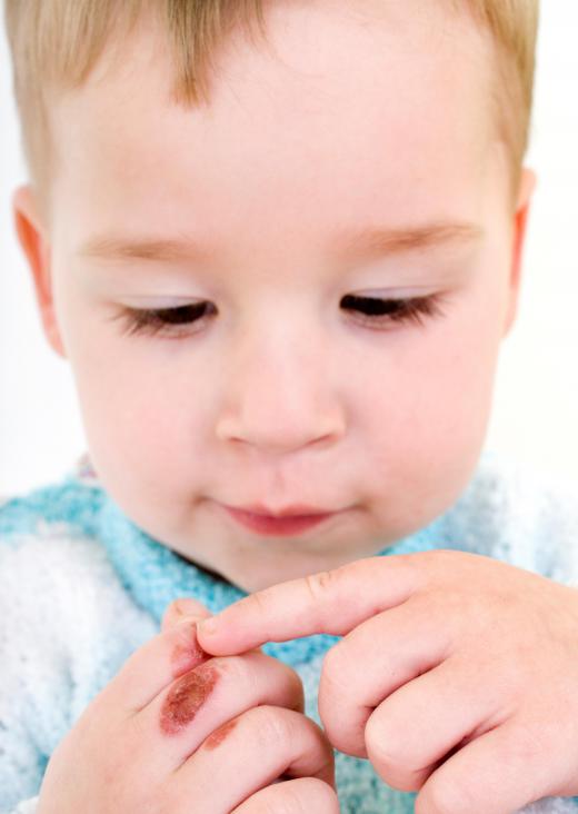 An oven lock may help prevent children from being burned.